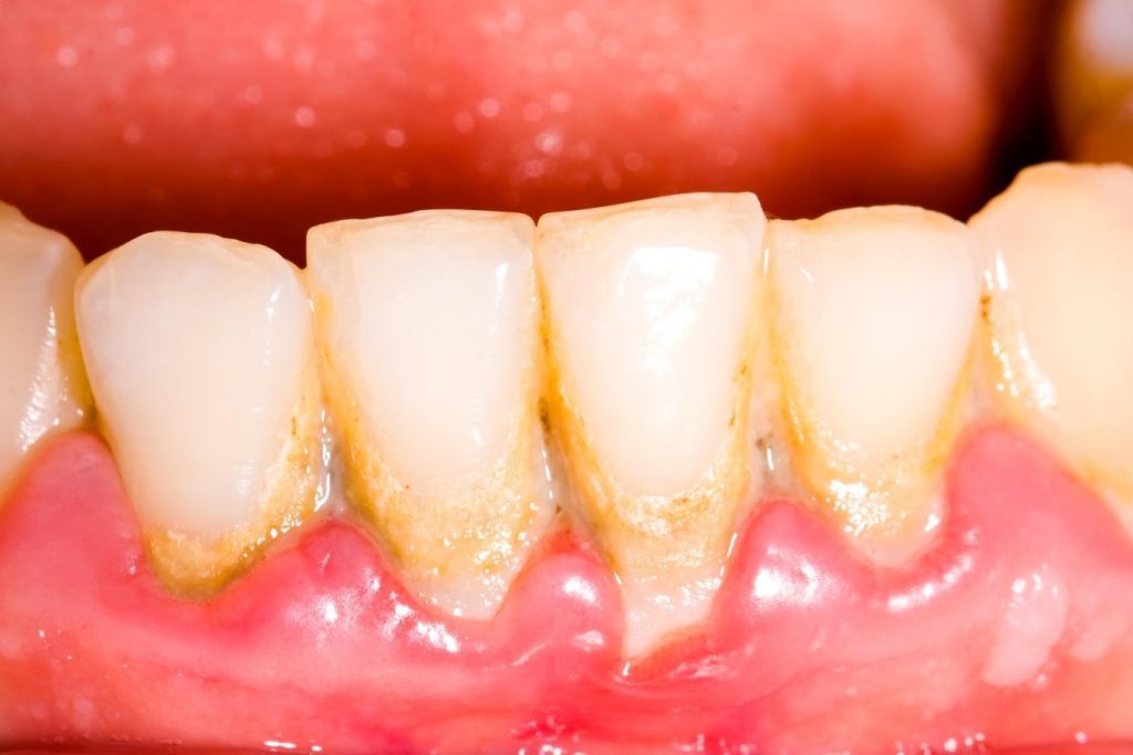 Phương pháp cạo vôi răng phổ biến