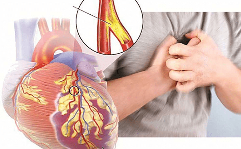 Gói khám tầm soát tim mạch 