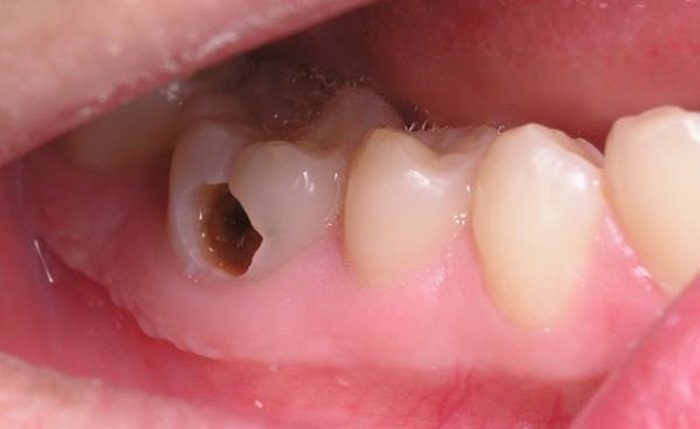 Răng bị thủng do sâu răng 